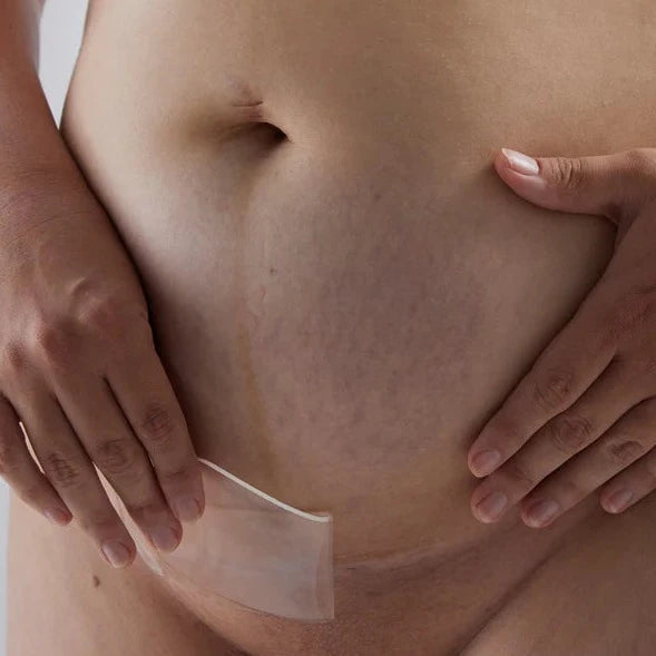 Close-up of a person's torso with one hand pulling down a Bare Mum Silicone Gel Scar Strip to reveal healing scars hydrated by silicone gel.